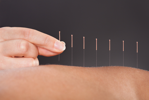 Acupuncture: Can It Help During Addiction Recovery?